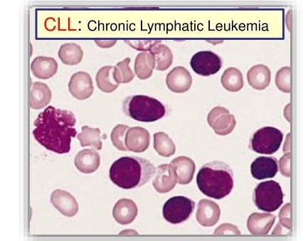 Chronic Lymphocytic Leukemia Oncomd Chronic Lymphocytic Leukemia Oncomd