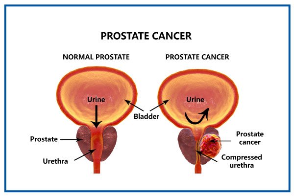 prostate-cancer